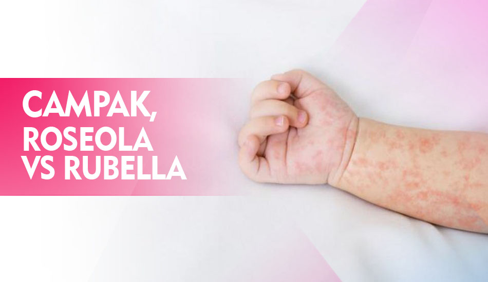 Perbedaan Roseola, Campak dan Rubella