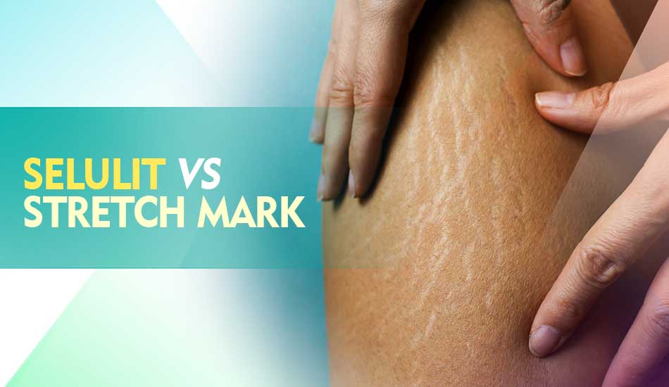 Perbedaan Selulit dan Stretch Mark